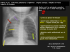 cul de sac pleural D émoussé - Les cliniques radiologiques de l