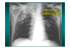 pneumonie tuberculeuse - Soutien Pneumologique International