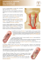 Traitement de l`artérite des carotides par endartériectomie