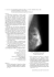 La macrobiopsie stéréotactique (11-gauge) assistée par le vide sur