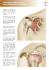 Traitement endoscopique des calcifications de l`épaule