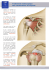 Traitement endoscopique des calcifications de l`épaule